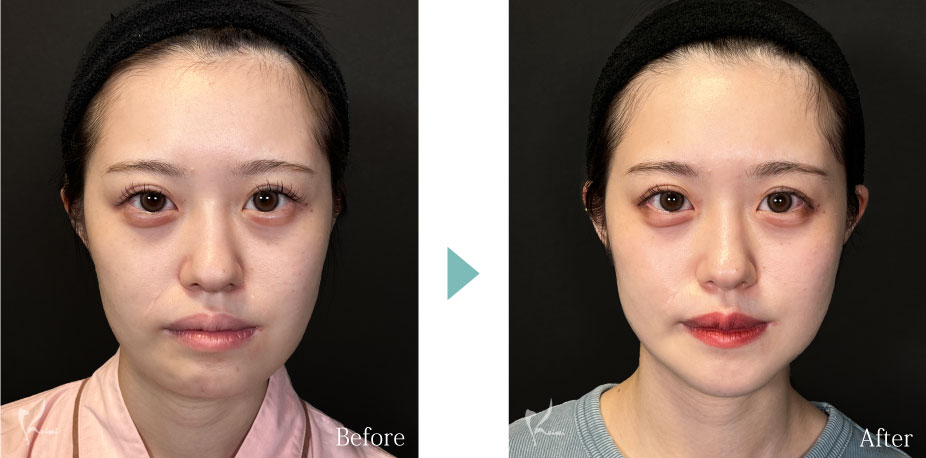 Vライン形成（エラ+顎）：エラの骨切り（下顎角形成）とアゴ（オトガイ形成）症例写真2（正面）