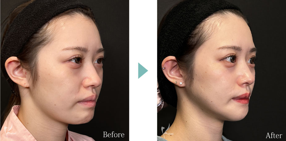 Vライン形成（エラ+顎）：エラの骨切り（下顎角形成）とアゴ（オトガイ形成）症例写真2（斜め）