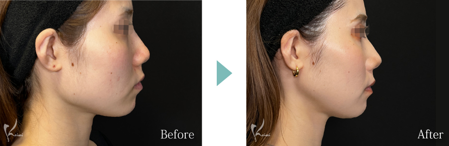 エラ骨切り（下顎角形成）症例