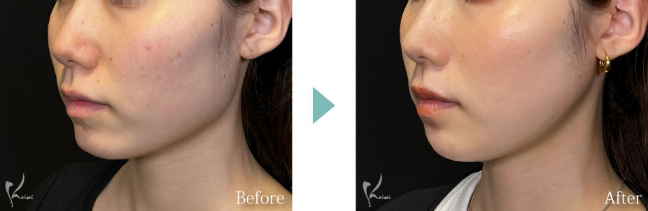 エラ骨切り（下顎角形成）症例