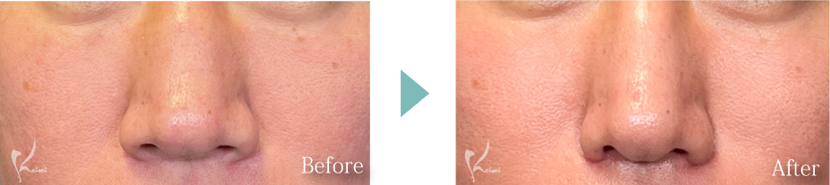 小鼻縮小（鼻翼縮小）の症例写真