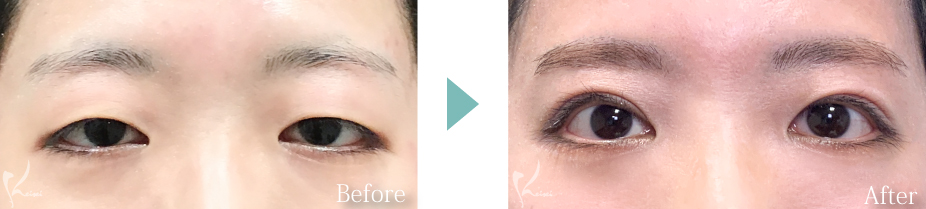 眼瞼下垂の症例写真