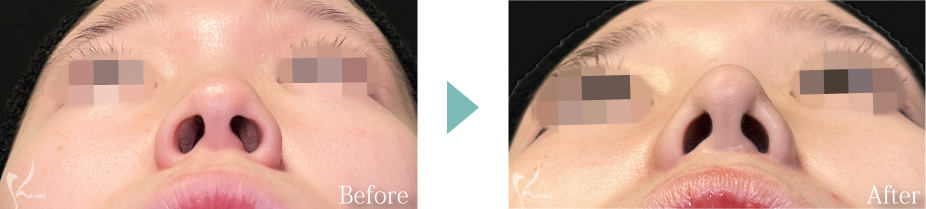 鼻骨骨切り術（鼻骨幅縮小術）＋鼻尖形成＋小鼻縮小（鼻翼縮小）＋鼻中隔延長（耳介軟骨移植）の症例写真