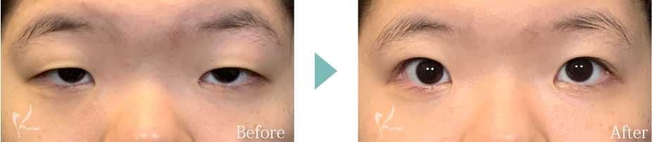 眼瞼下垂の症例写真