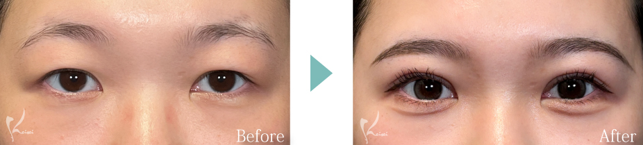 全切開法の症例写真