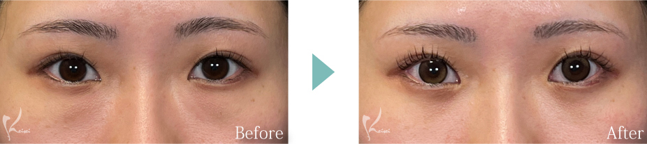 目の下の脱脂法の症例写真