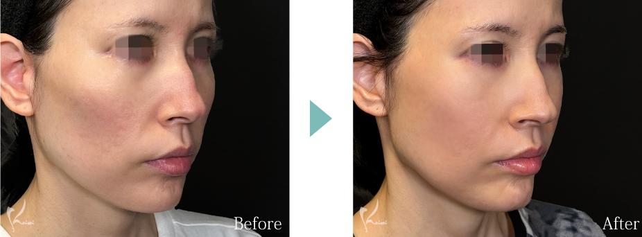 頬骨骨切り（頬骨形成術）症例