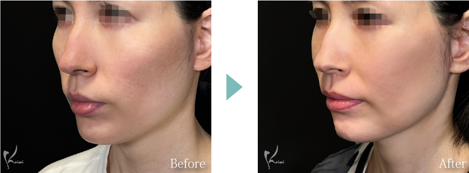 頬骨骨切り（頬骨形成術）症例