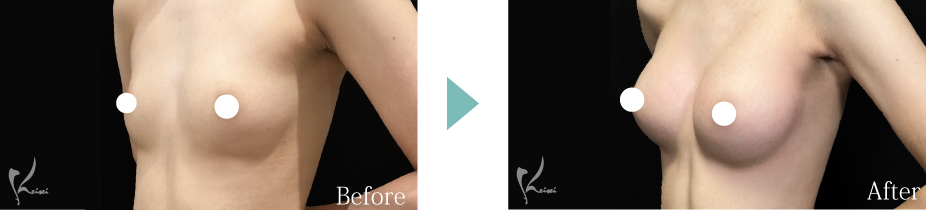 シリコンバッグ豊胸症例