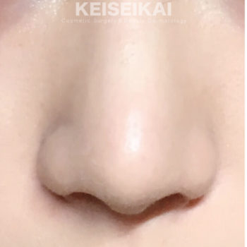 鼻尖形成と小鼻縮小でスッキリとした鼻へ