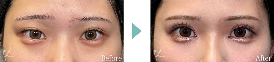 全切開法の症例写真