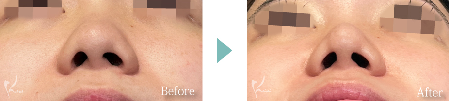 鼻尖形成の症例写真