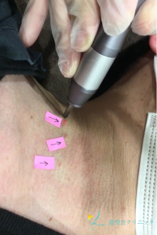 CO2レーザー（炭酸ガスレーザー）受けました！