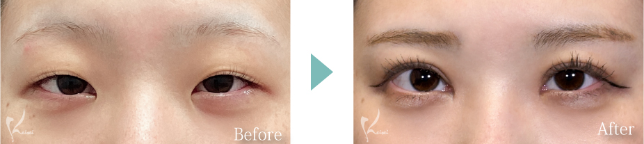 目頭切開＋眼瞼下垂の症例写真