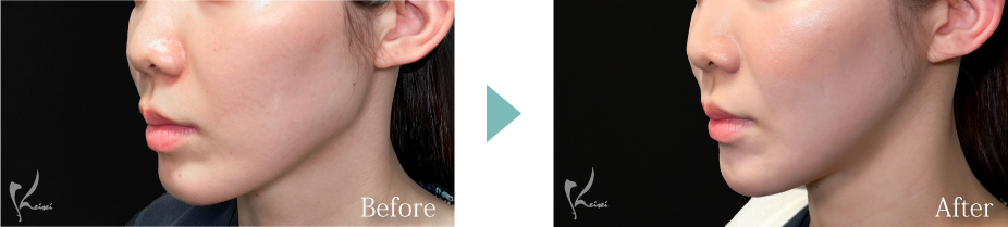 Vライン形成の症例写真