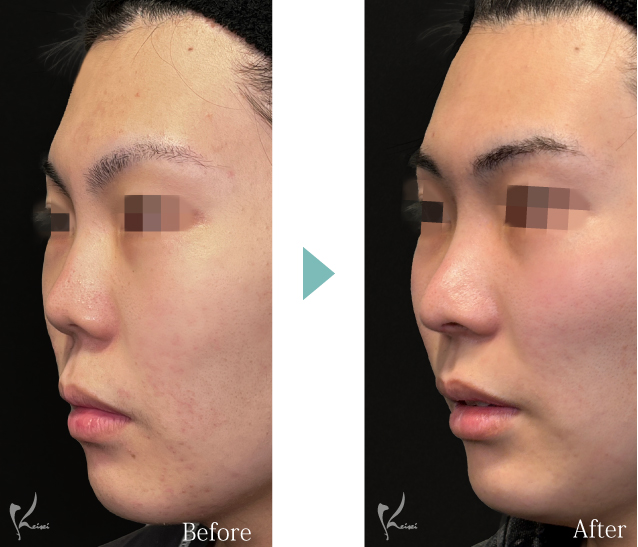 鼻尖形成＋鼻骨骨切り術（鼻骨幅縮小術）＋鼻中隔延長（肋軟骨移植）の症例写真