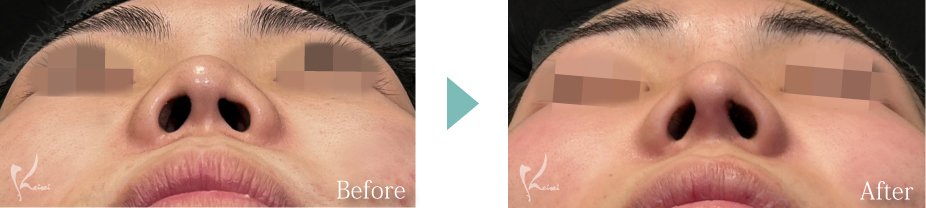 鼻尖形成＋鼻骨骨切り術（鼻骨幅縮小術）＋鼻中隔延長（肋軟骨移植）の症例写真