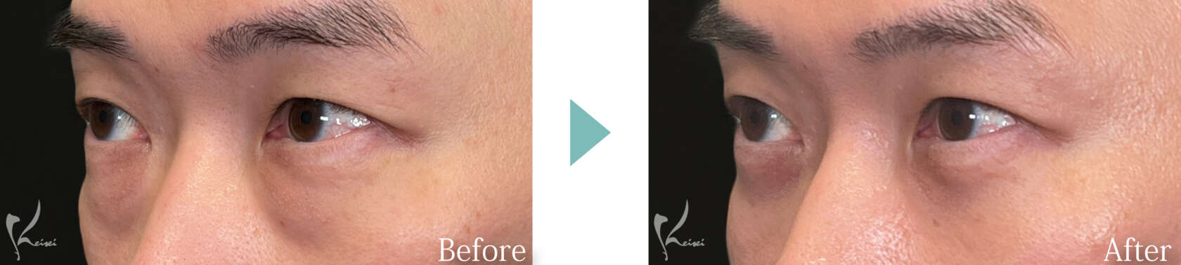 目の下の脱脂法の症例写真