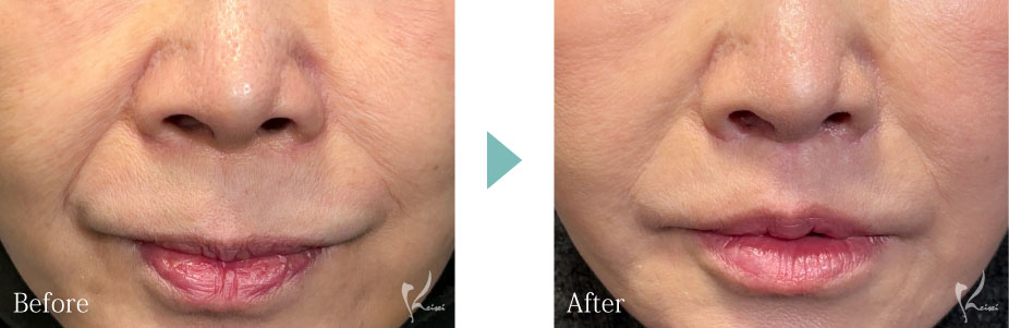 人中短縮症例写真