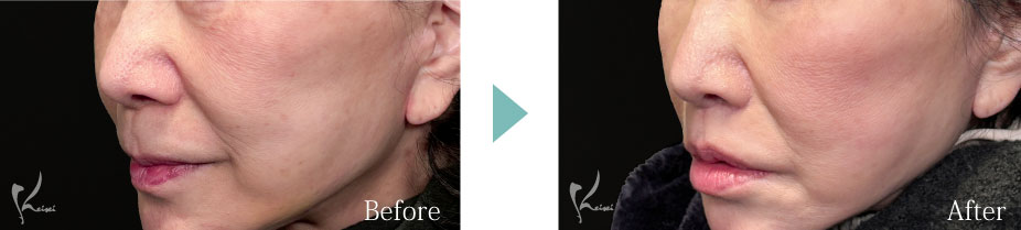 人中短縮術（リップリフト）モニター写真2