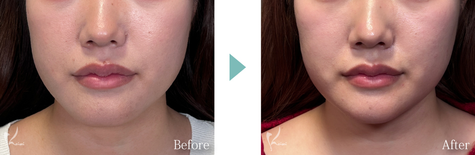 オトガイ形成（顎骨切り）症例