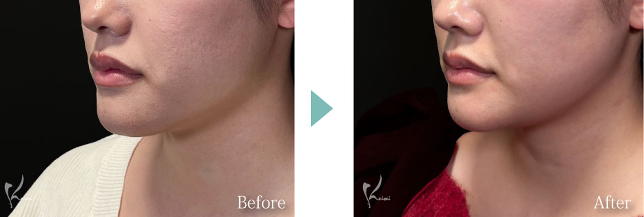 オトガイ形成（顎骨切り）症例