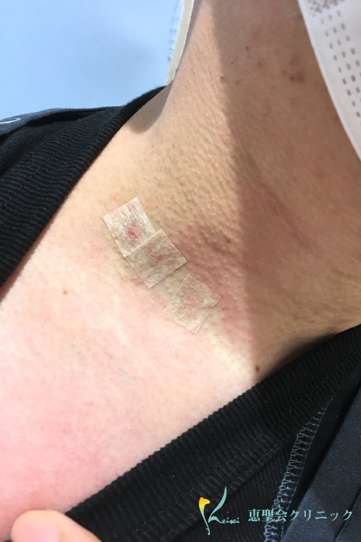 CO2レーザー（炭酸ガスレーザー）受けました！