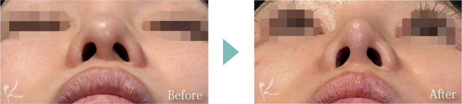 鼻尖形成＋隆鼻術（プロテーゼ）＋鼻中隔延長（耳介軟骨移植）の症例写真