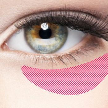 目の下の脱脂 影くま 黒くま 大阪 脂肪取り