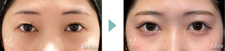 MT埋没法の写真