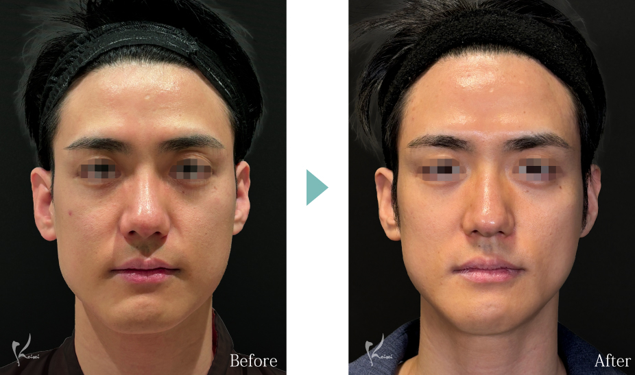 Vライン形成（エラ+顎）：エラの骨切り（下顎角形成）とアゴ（オトガイ形成）症例写真