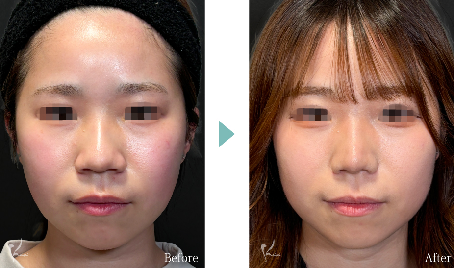 小鼻縮小（鼻翼縮小）＋鼻尖形成＋鼻中隔延長（耳介軟骨移植）の症例写真