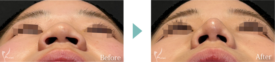 小鼻縮小（鼻翼縮小）＋鼻尖形成＋鼻中隔延長（耳介軟骨移植）の症例写真