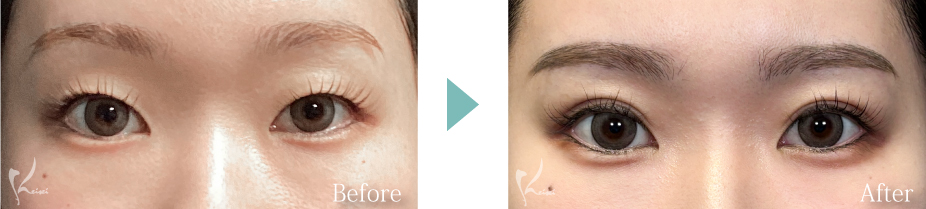 MT埋没法の写真