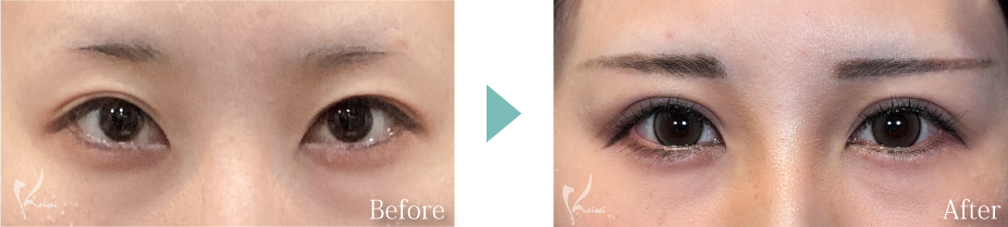 全切開法+下眼瞼下制術（垂れ目形成術）の写真