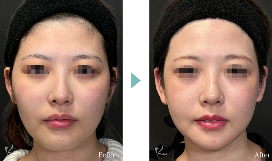 術前・術後　正面の症例