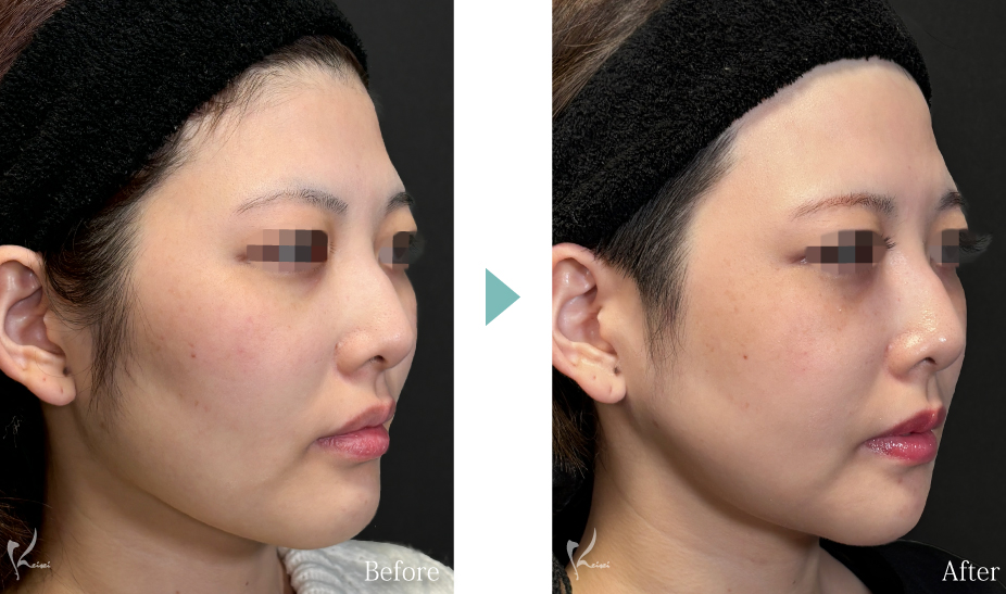 術前・術後　斜めの症例