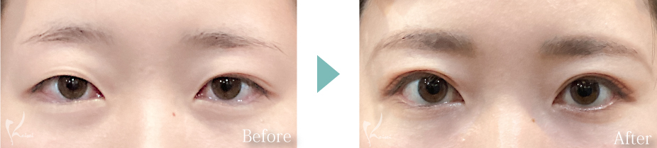 全切開法の症例写真