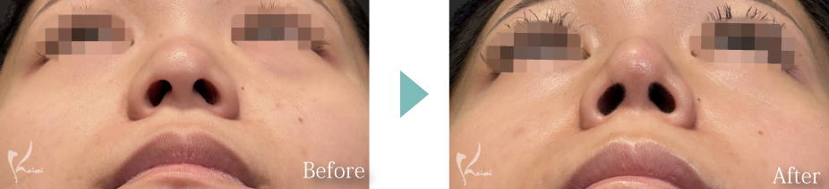 鼻尖形成＋隆鼻術（プロテーゼ）＋鼻中隔延長（耳介軟骨移植）の症例写真