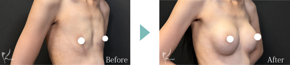 シリコンバッグ豊胸症例