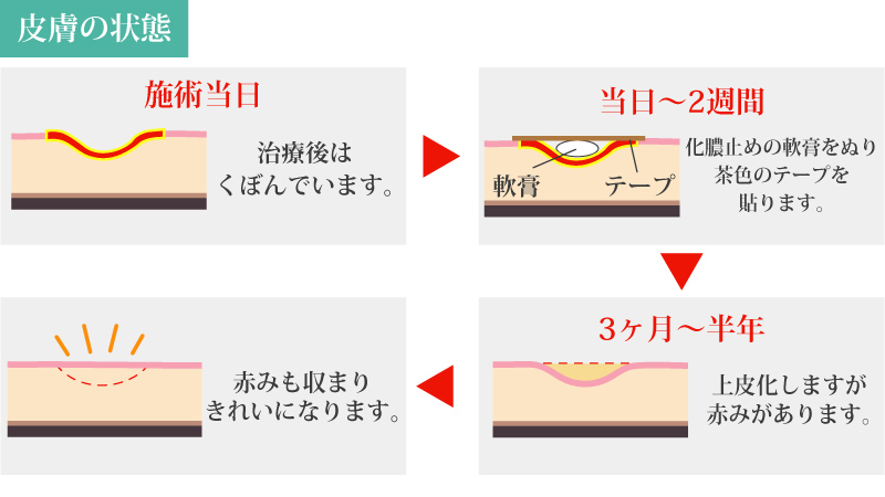 ホクロ除去 ホクロ取り CO2レーザー 経過