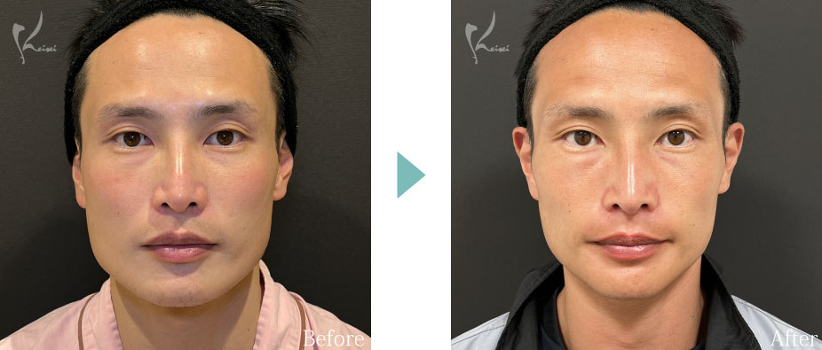 Vライン形成（エラ+顎）：エラの骨切り（下顎角形成）とアゴ（オトガイ形成）症例写真1（正面）