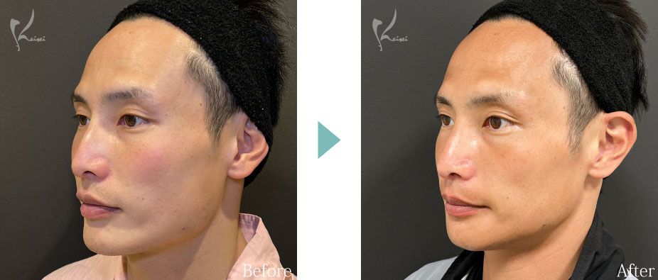 Vライン形成（エラ+顎）：エラの骨切り（下顎角形成）とアゴ（オトガイ形成）症例写真2（斜め）