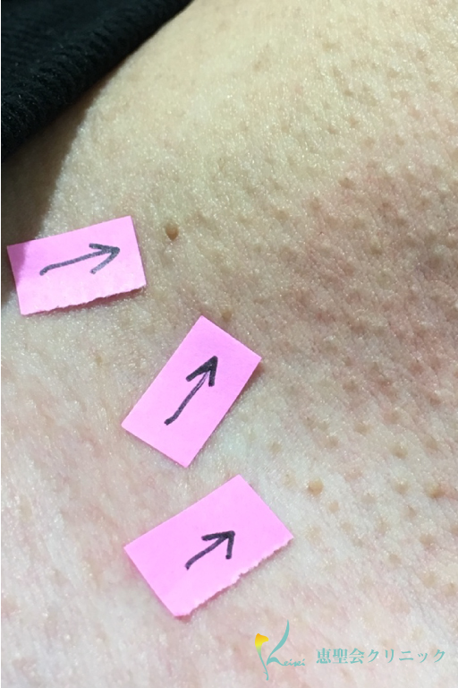 CO2レーザー（炭酸ガスレーザー）受けました！