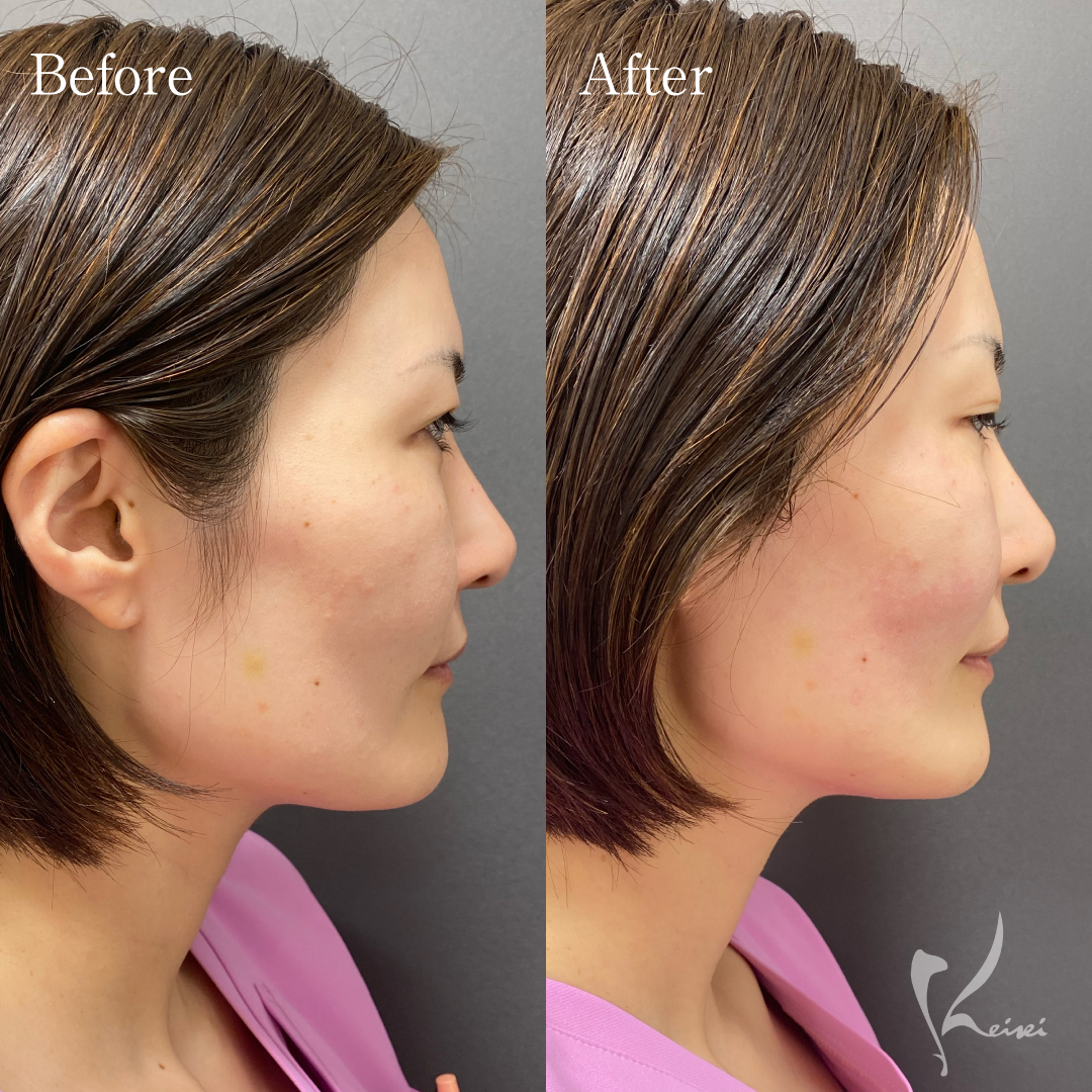 ハイフのビフォーアフター