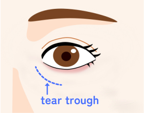 tear trough