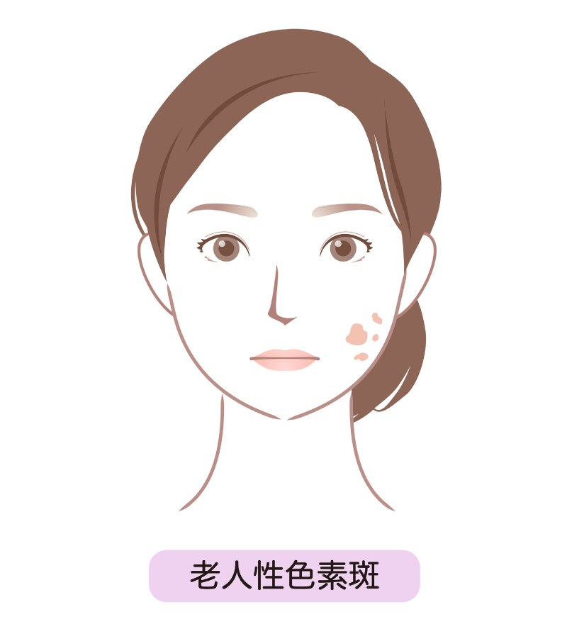 老人性色素斑イメージ