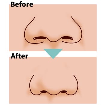 小鼻縮小術を解説！術式の違いと向いている方とは？ サムネイル