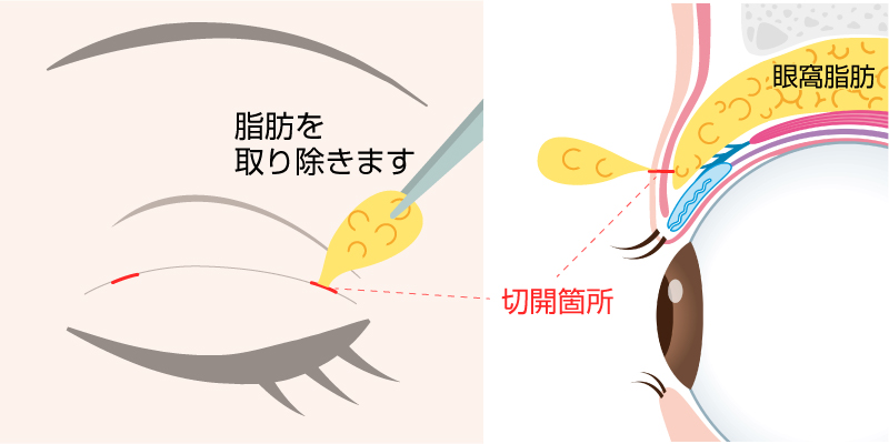 二重脱脂法