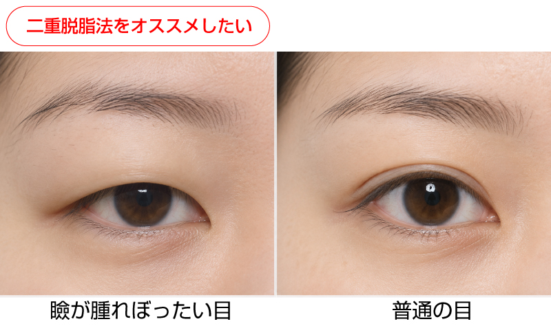 瞼が腫れぼったい目比較
